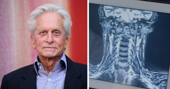 Expert reveals why HPV-related throat cancer is rising among men due to oral sex